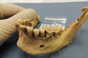 Late Iron Age/Roman woman showing large dental calculus deposit, from Cambridge area, UK. Photo: Alan Cooper